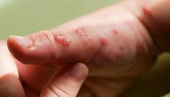 Cifra de contagios de viruela del mono creció 8,97%