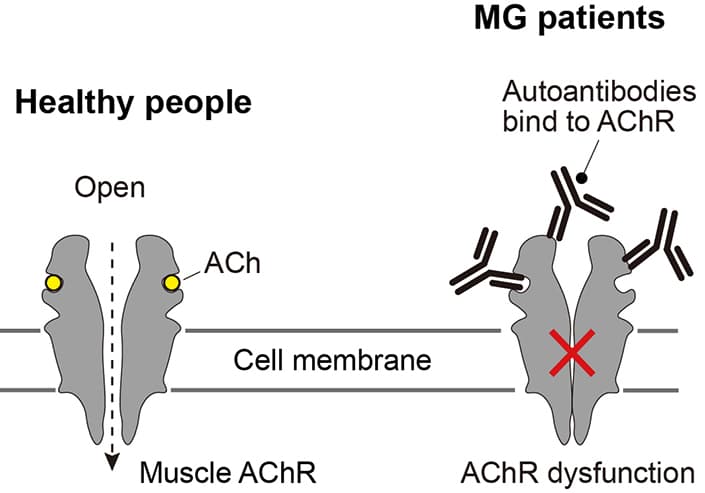 Avances en la miastenia grave: descubriendo mecanismos